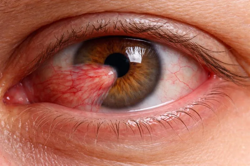 Cirugía de Pterigion